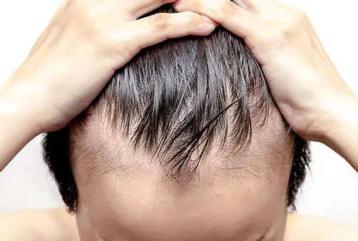 Derma roller / Micro needling | Hair Loss Treatment Bangalore
