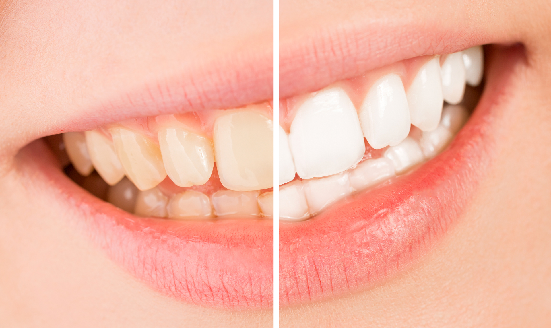 teeth bleaching / whitening