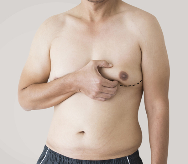 what does gynecomastia surgery cost in bangalore, india?