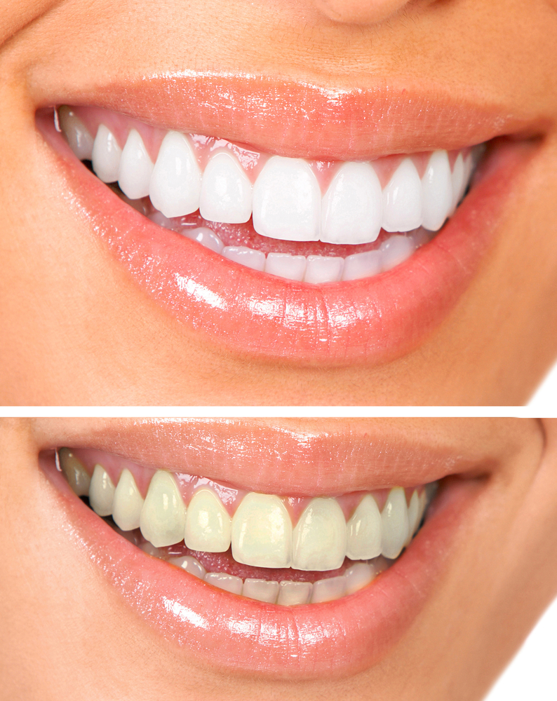 dr. karishma aesthetics’ teeth whitening procedures: