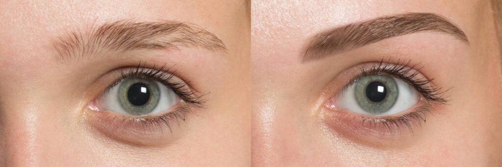 Eyebrow Hair Restoration in Bangalore at DR. Karishma Aesthetics