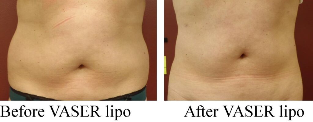 VASER Liposuction vs Traditional Liposuction | Dr Karishma