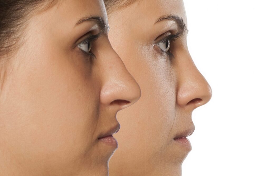 Rhinoplasty Surgery | Nose Job Cost in Bangalore