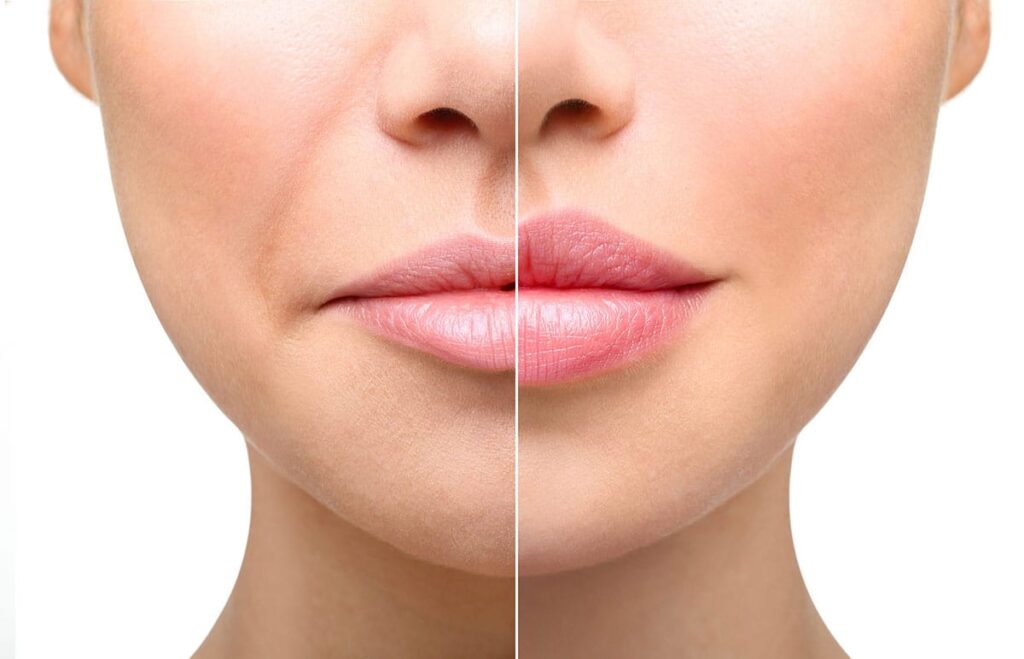 The Science of Lip Augmentation: Achieving Fuller, Natural Lips