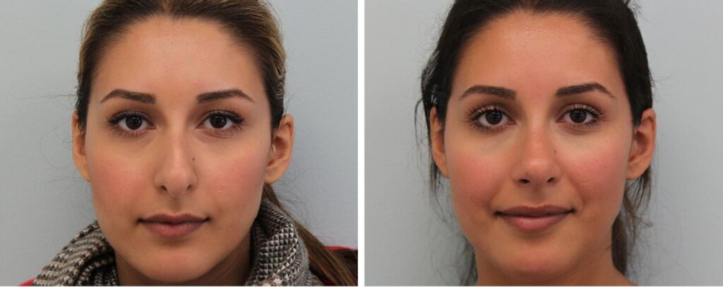 Rhinoplasty Nose Job