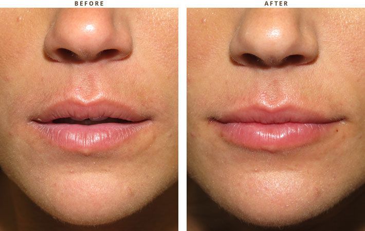 What is Lip Lift, And Are You the Right Fit for Restoring the Youthful Appearance?