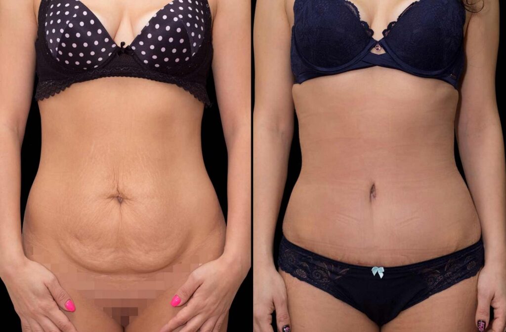 Fleur-de-Lis Abdominoplasty