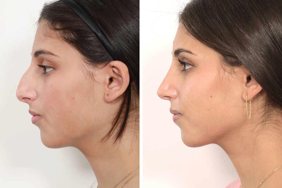 Basics of Ethnic Rhinoplasty: Top Points One Should Be Aware of