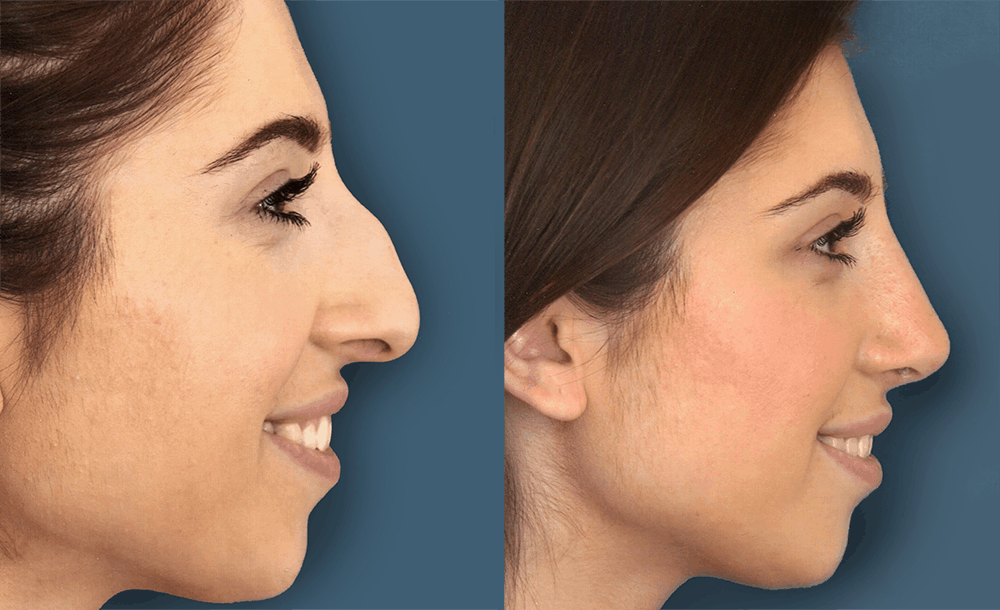 How to Know If You Need Revision Rhinoplasty