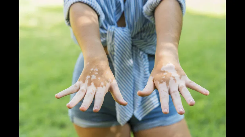 Psoriasis & Vitiligo