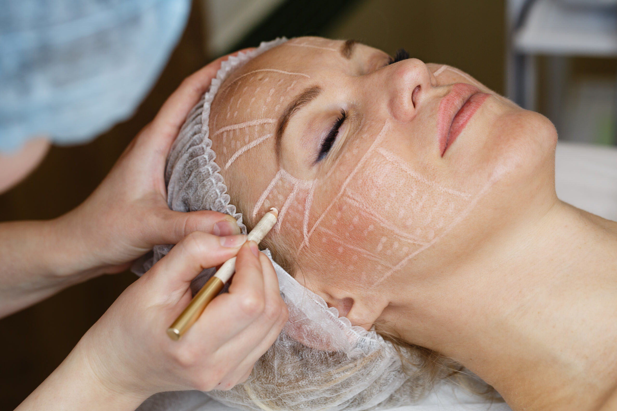 Facelift Surgery