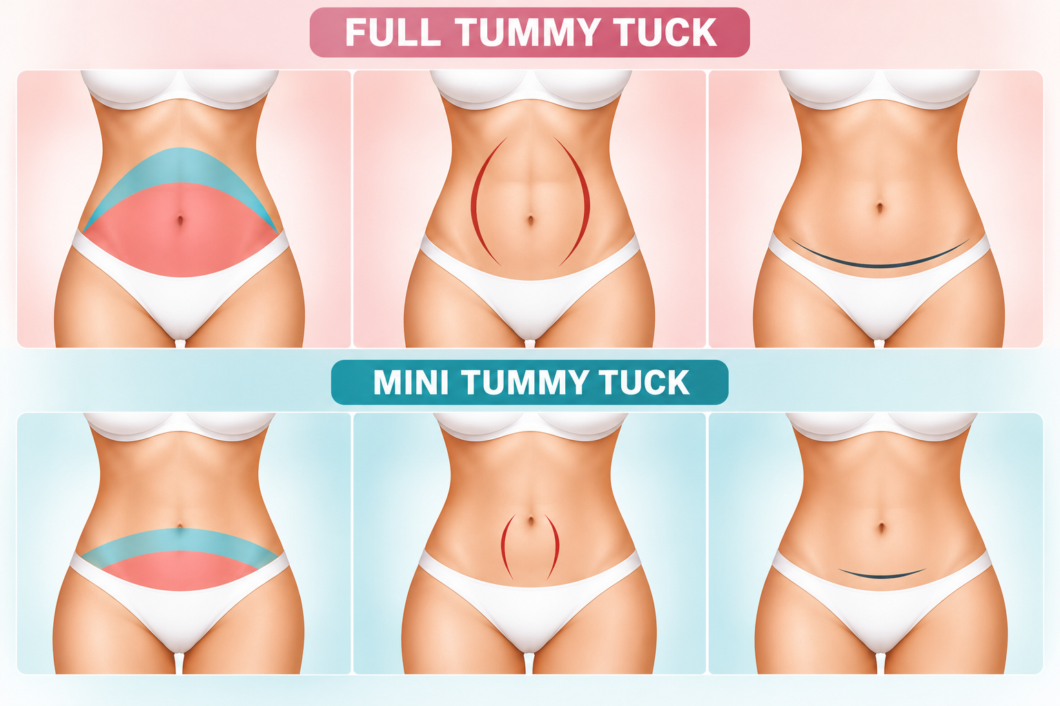 Mini Tummy Tuck or Full Tummy Tuck: What Should Be Your Option?