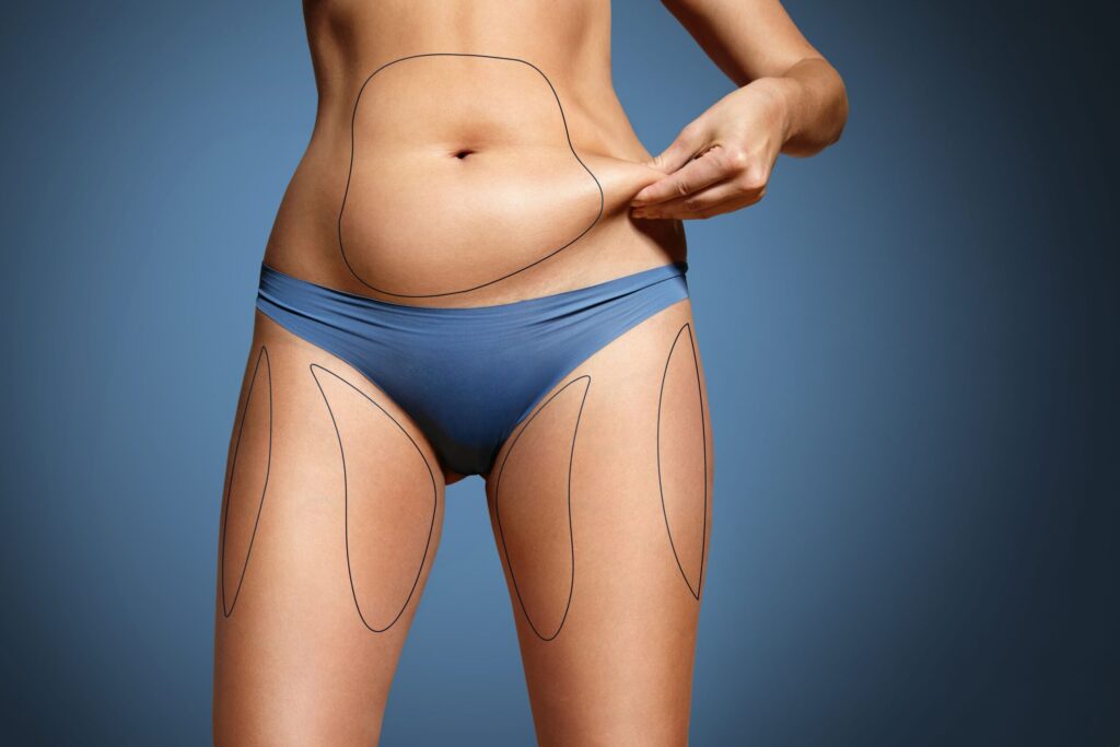 How long does Vaser Lipo last