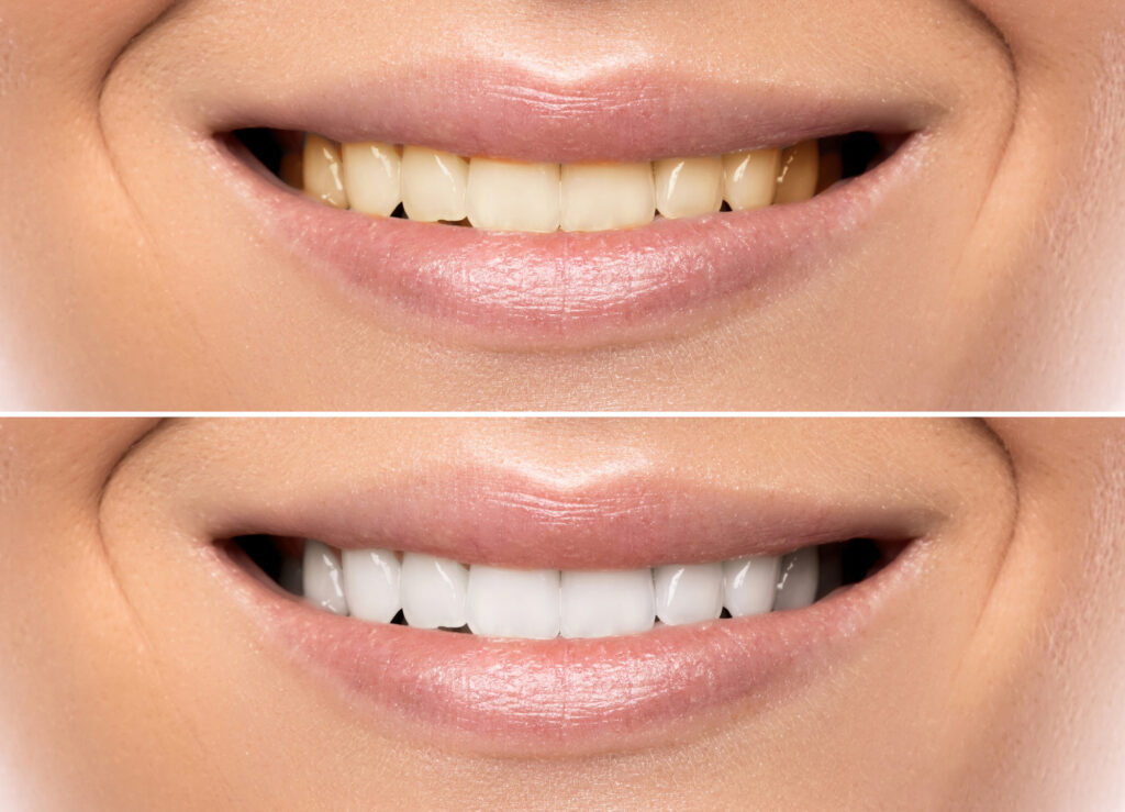 Teeth Whitening in Bangalore | Teeth Bleaching Guide
