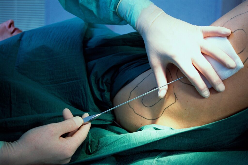 Can liposuction surgery be harmful for human body