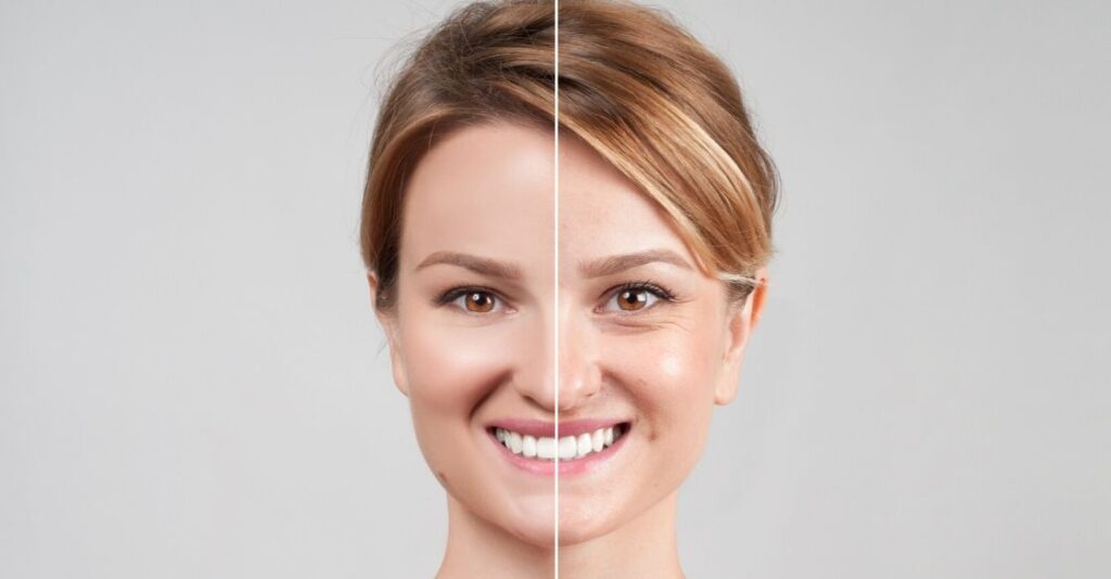 Can I Have a Facelift in My 30s