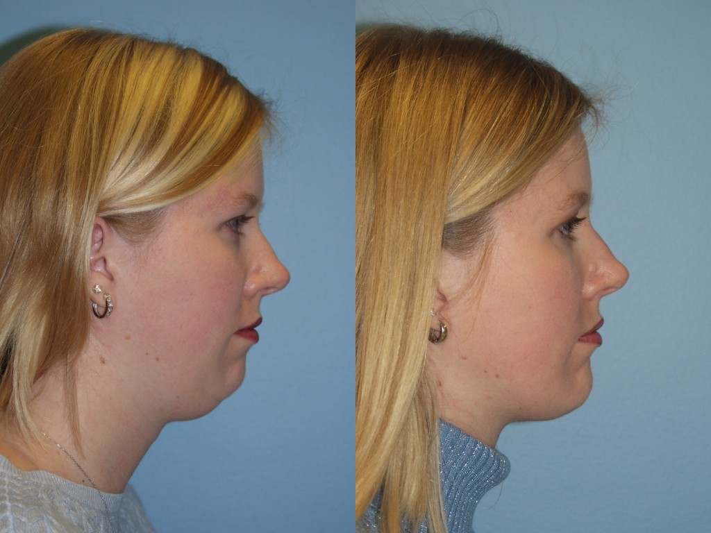 Why is Liposuction the Most Popular Plastic Surgery in the World
