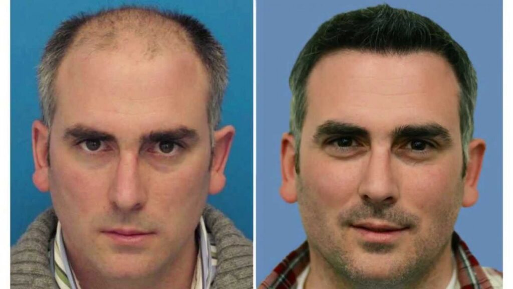 How to fix Thinning Eyebrows with Hair Transplant Procedure in Bangalore