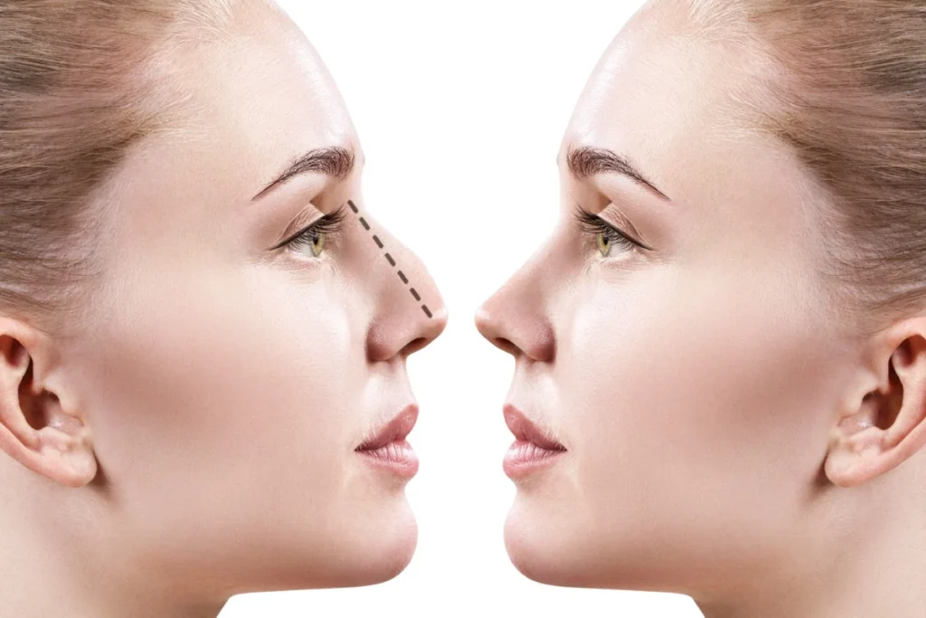 What are the top 4 Tips for Facial feminization Rhinoplasty/ Nose Job?