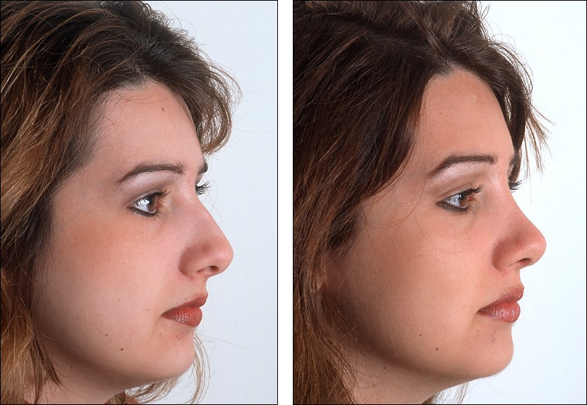 Top 5 FAQs about Rhinoplasty | Nose Job Procedure