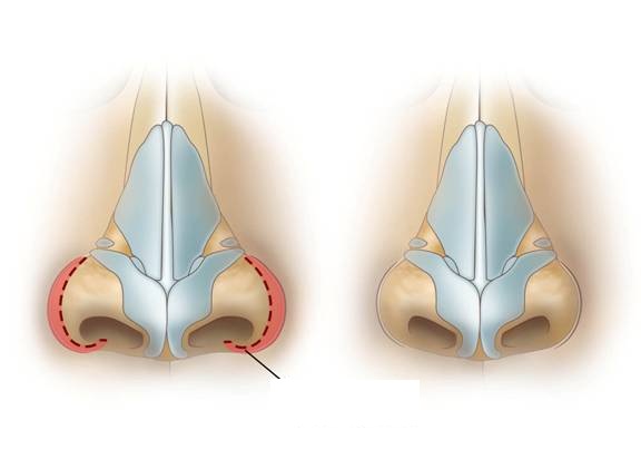 What is the difference between Alarplasty and Rhinoplasty?