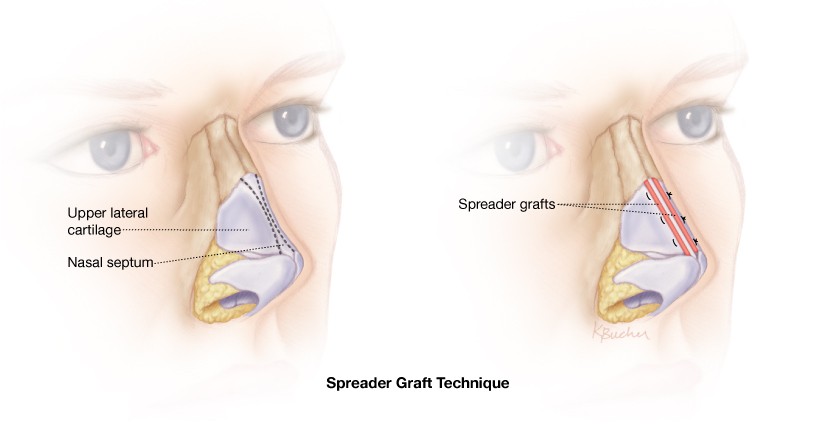What are Spreader Grafts: How does it improve breathing in patients with Chronic Nasal congestion?