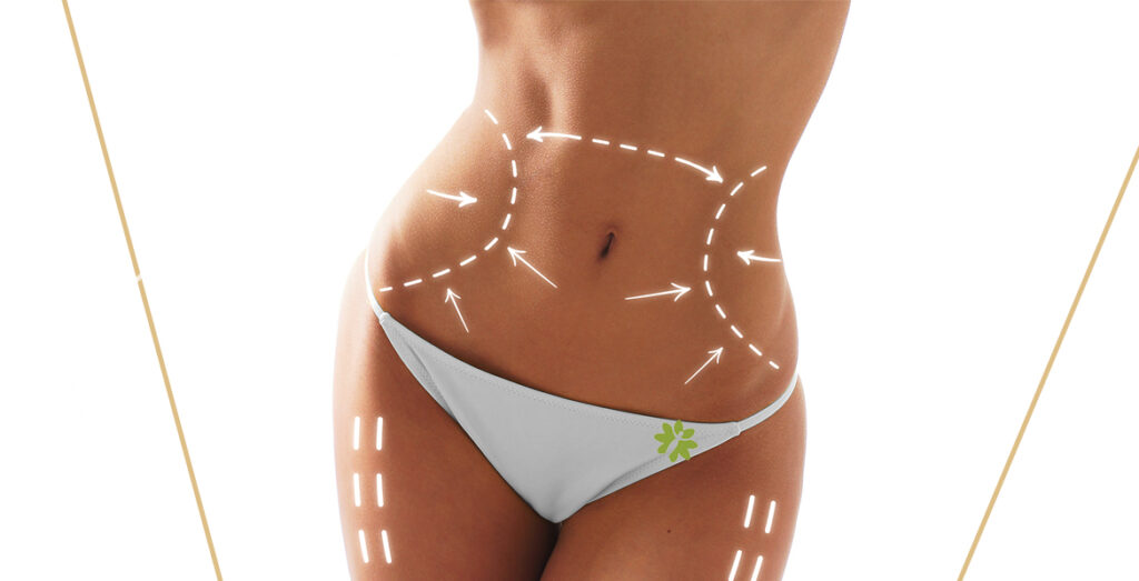 What Is VASER Liposuction? How It Works | Dr. Karishma