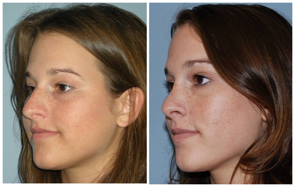 Septoplasty