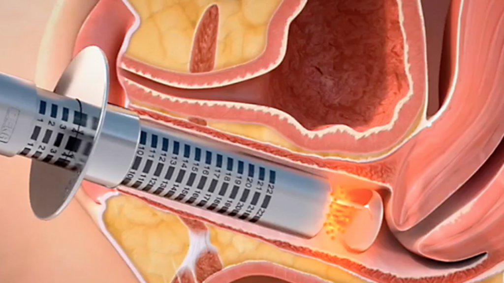 Why Should You Receive Laser Vaginal Rejuvenation: A Few Minutes Benefits Check