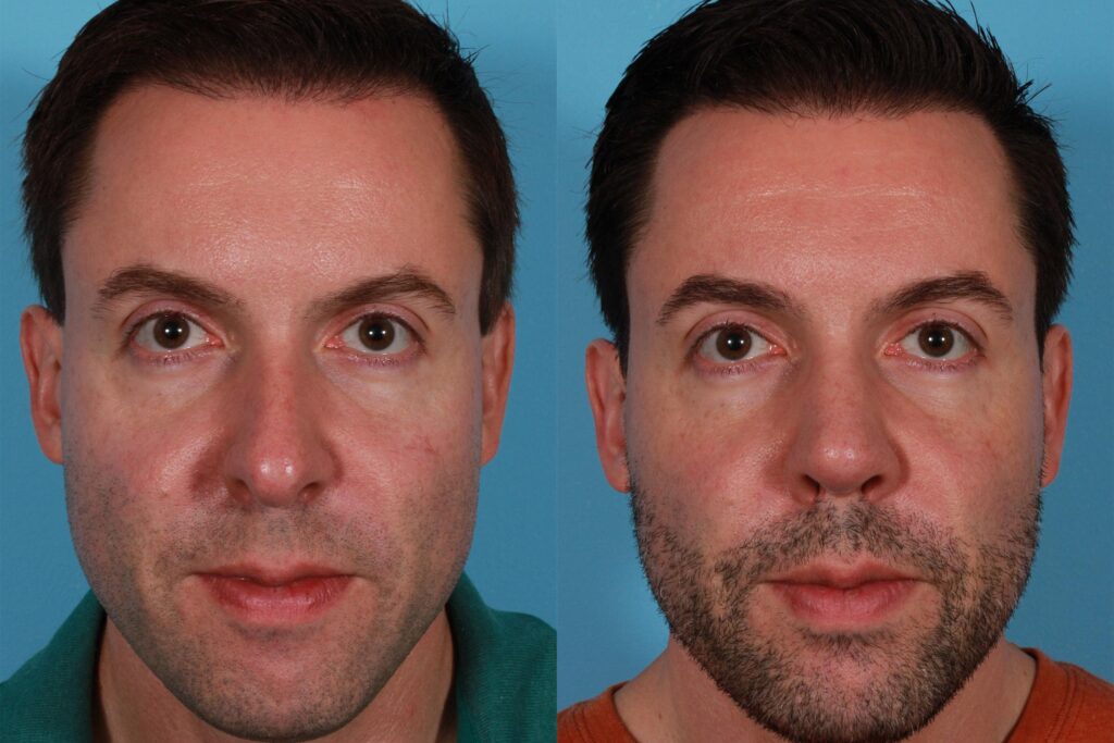 How to Correct Nasal Obstruction with Rhinoplasty: Top 4 Points to Know about