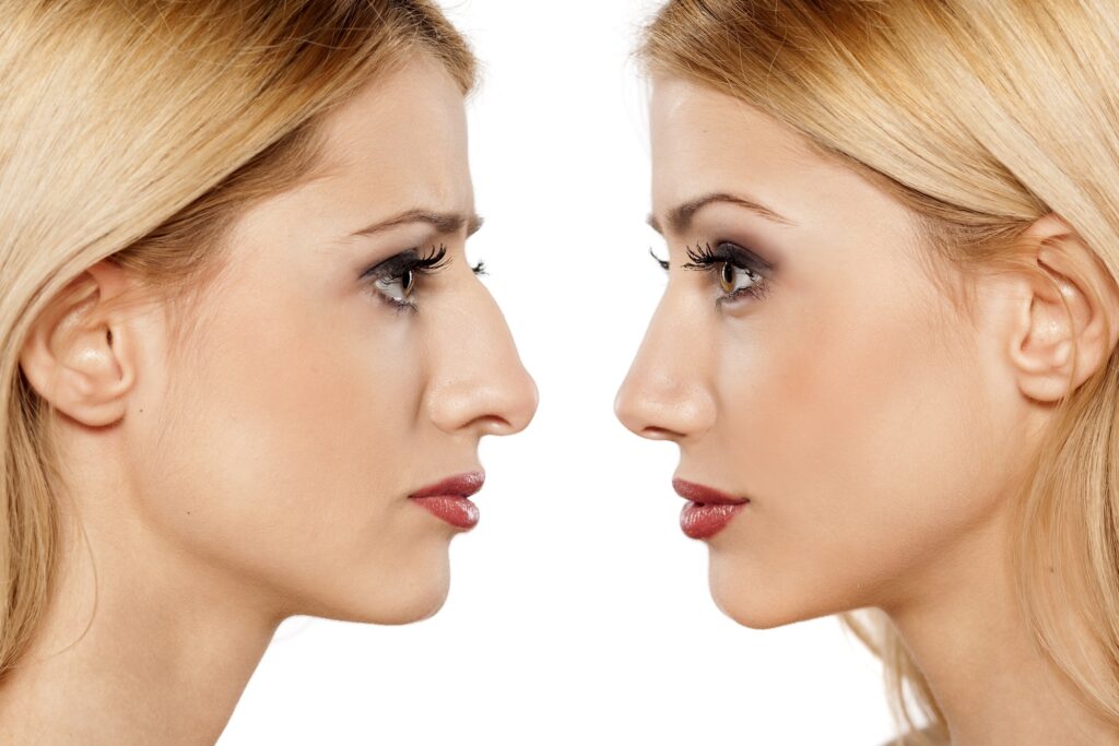 Surgical Rhinoplasty