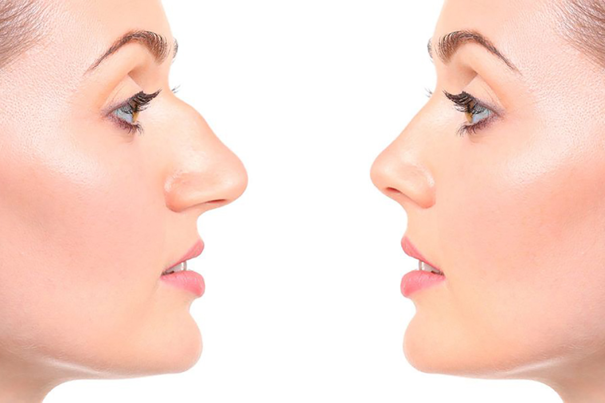 Nose Surgery in Bangalore