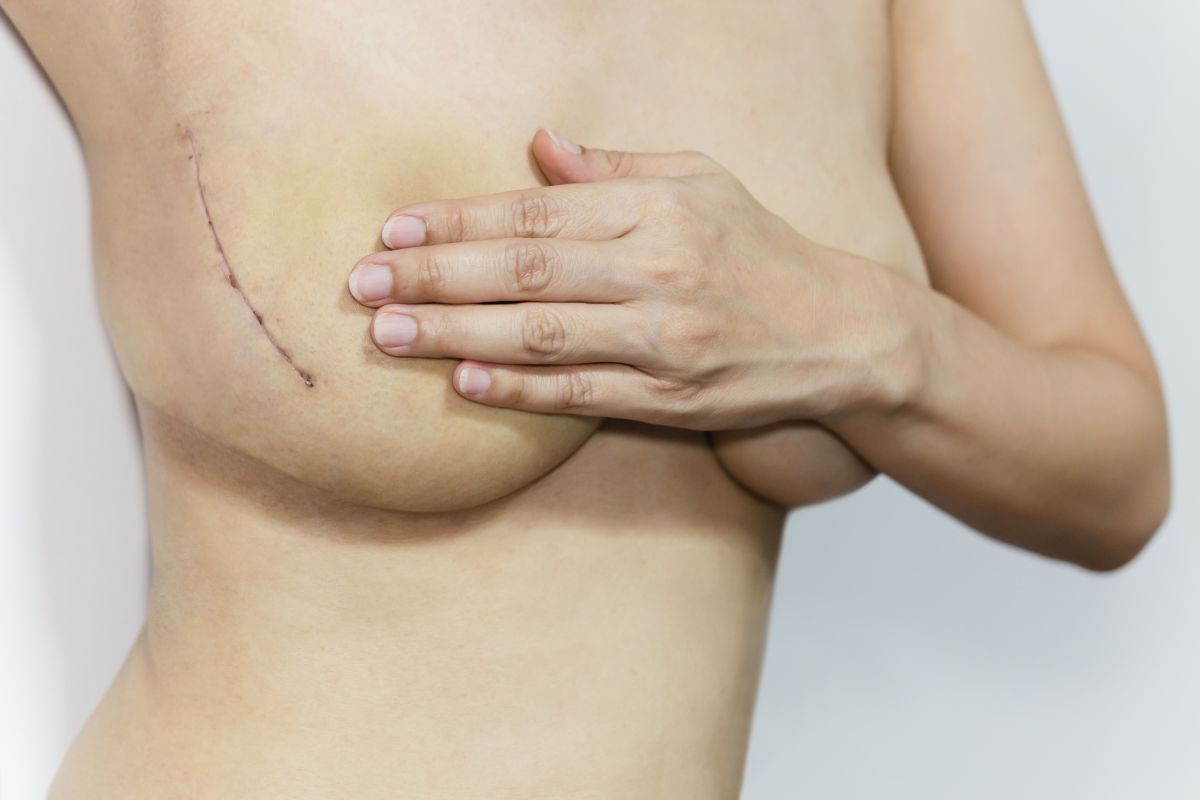 Breast lift scars