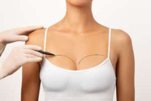 Breast Implants