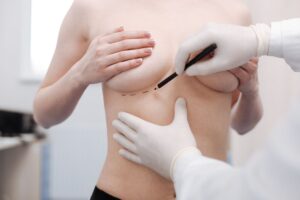 Breast reconstruction surgery
