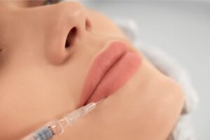 lip augmentation filler in Bangalore