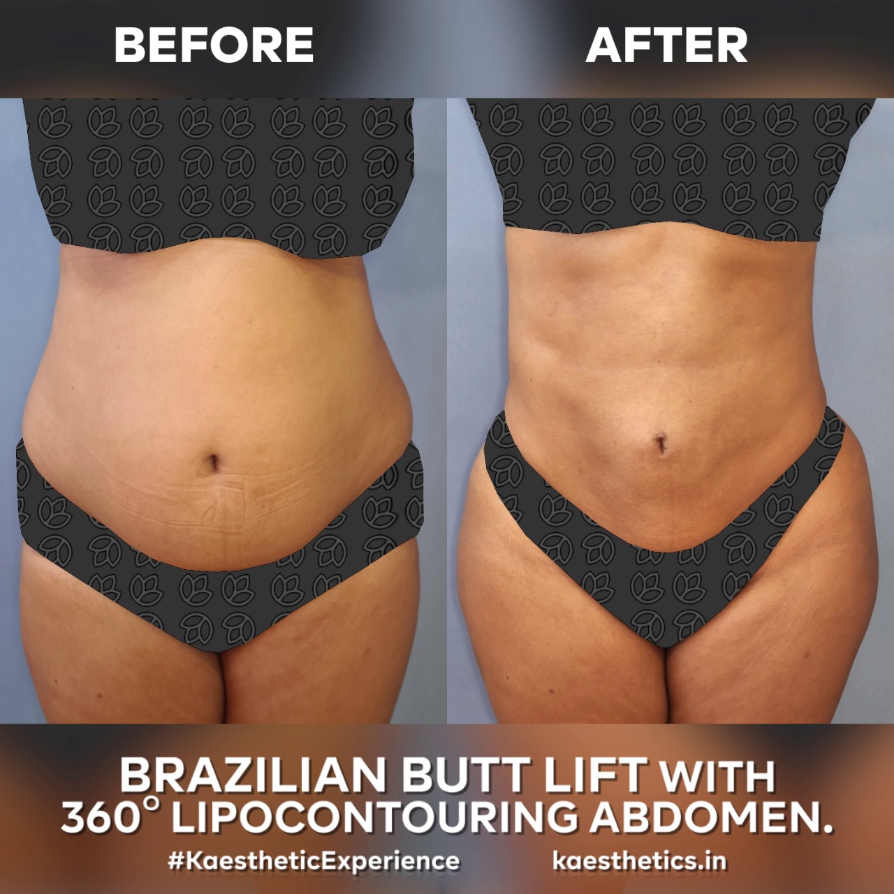Brazilian Butt Lift in Bangalore