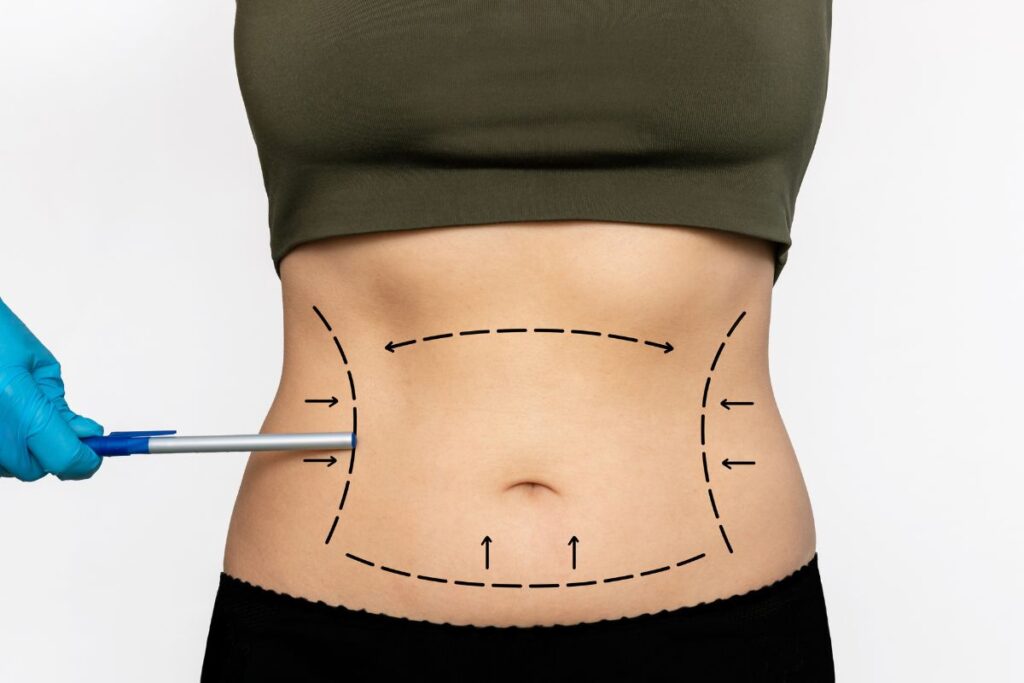 tummy tuck surgery in Bangalore