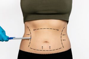 tummy tuck surgery in Bangalore