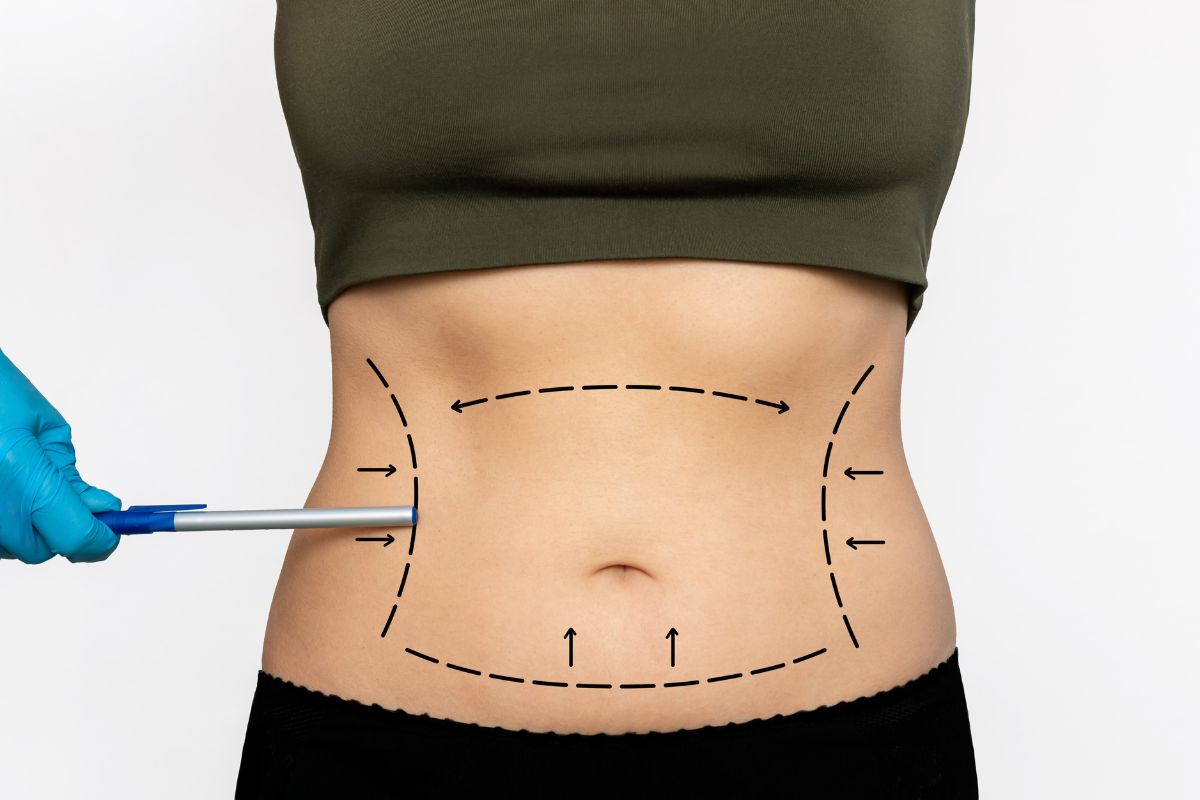 Tummy Tuck Surgery in Bangalore: Understanding Abdominoplasty Cost and What Influences the Price