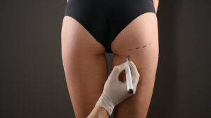 Buttock augmentation surgery in Bangalore