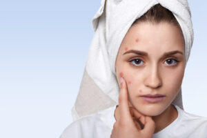 Pimples and Scars Treatment